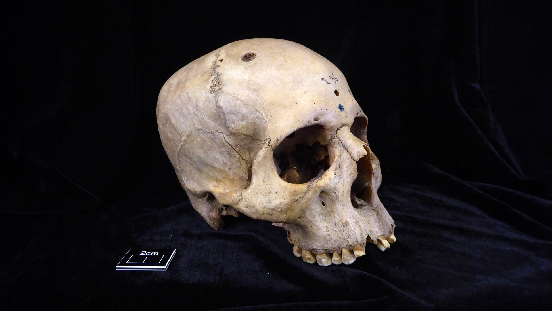 Featured image for Ancient Egyptian Skull Shows Early Cancer Surgery Attempts