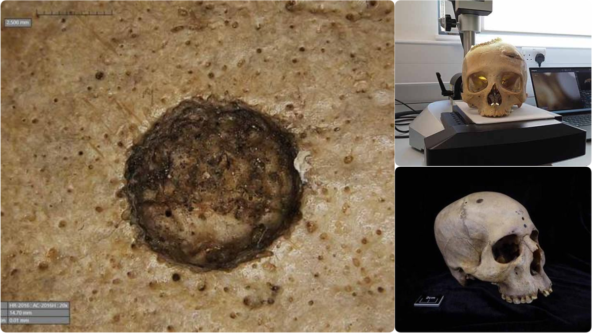 Ancient Egyptian Skull Reveals Early Cancer Treatment Attempts