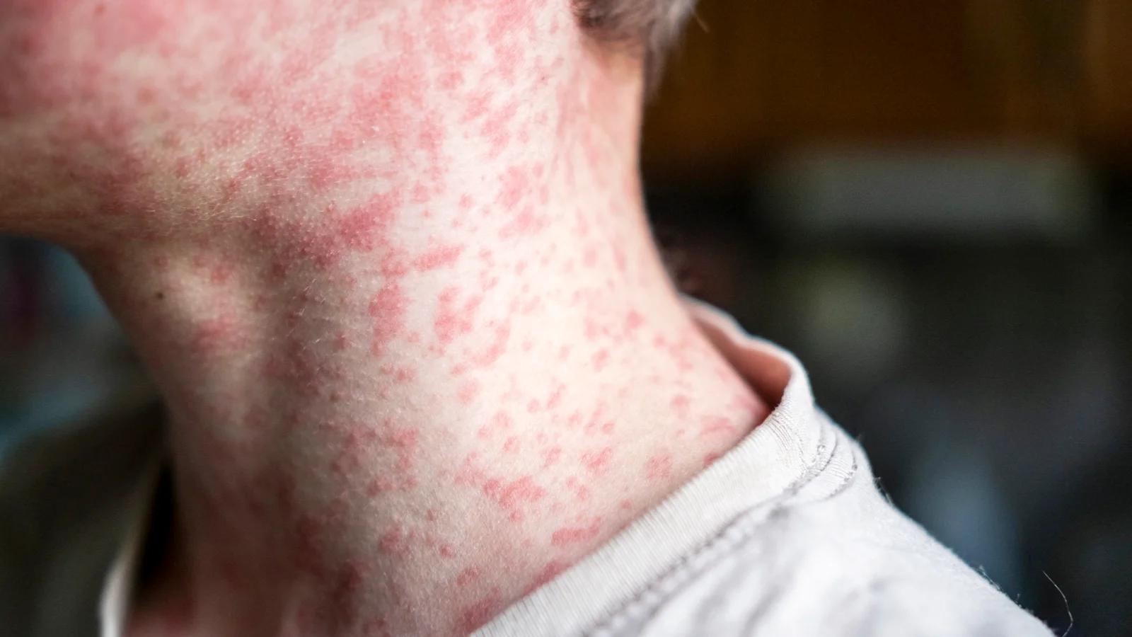 Measles resurges in the U.S., signaling cracks in public health readiness