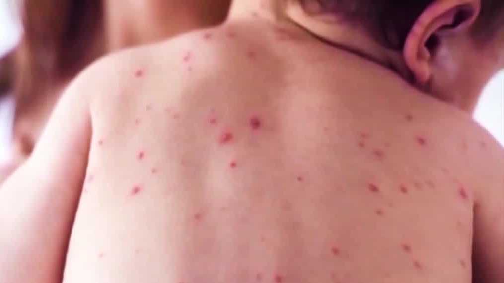 Featured image for US measles cases exceed 2,000 amid rising outbreaks in South Carolina