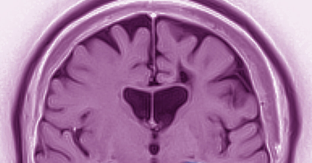 Featured image for Eli Lilly's Alzheimer's Drug Shows Promise in Slowing Cognitive Decline.