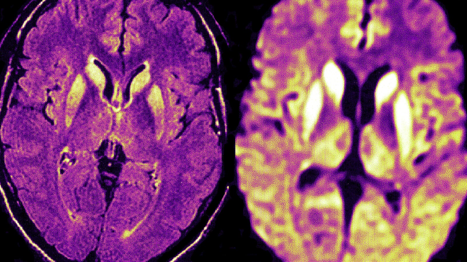 Featured image for The Alarming Surge of Prion Diseases in the U.S.