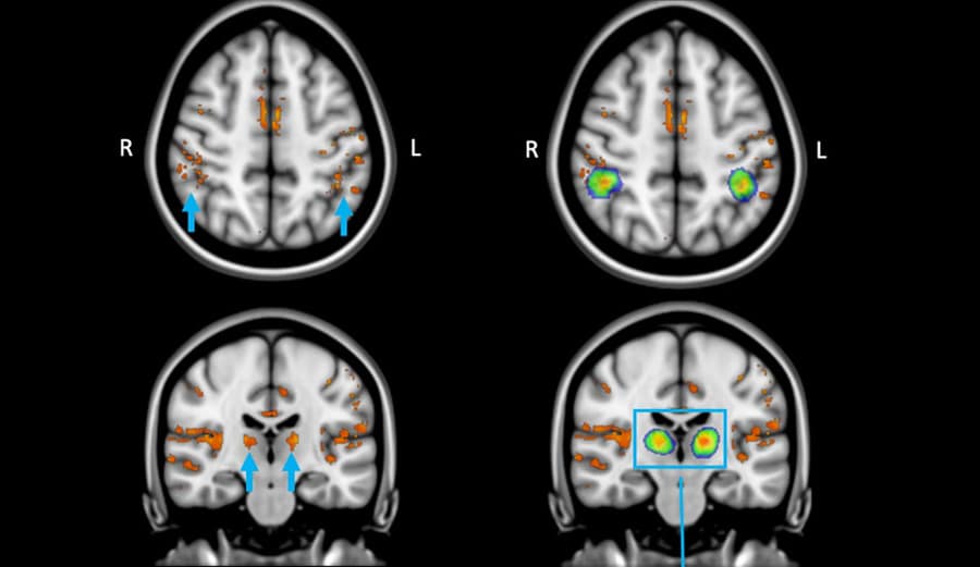 Featured image for "Unveiling the Brain's Response to Blue Light: Insights from Ultrahigh-field MRI"