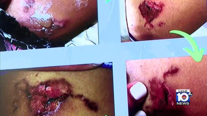 Featured image for Jury awards $800K in hot McNugget lawsuit, leaving girl severely burned