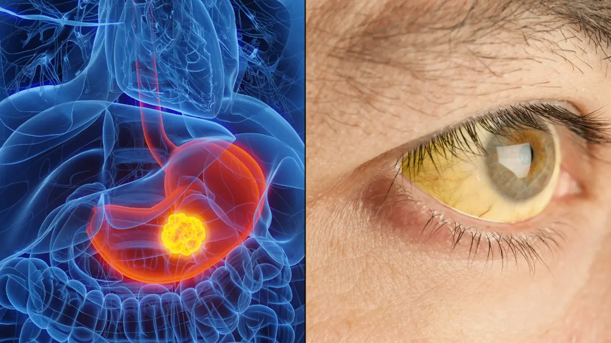 Surge in Rare Cancers Among Young People Linked to Common Factors