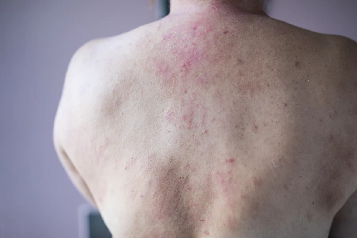 Featured image for "Unraveling a Startling Cause: The Medical Mystery of Years of Hives and Fevers"