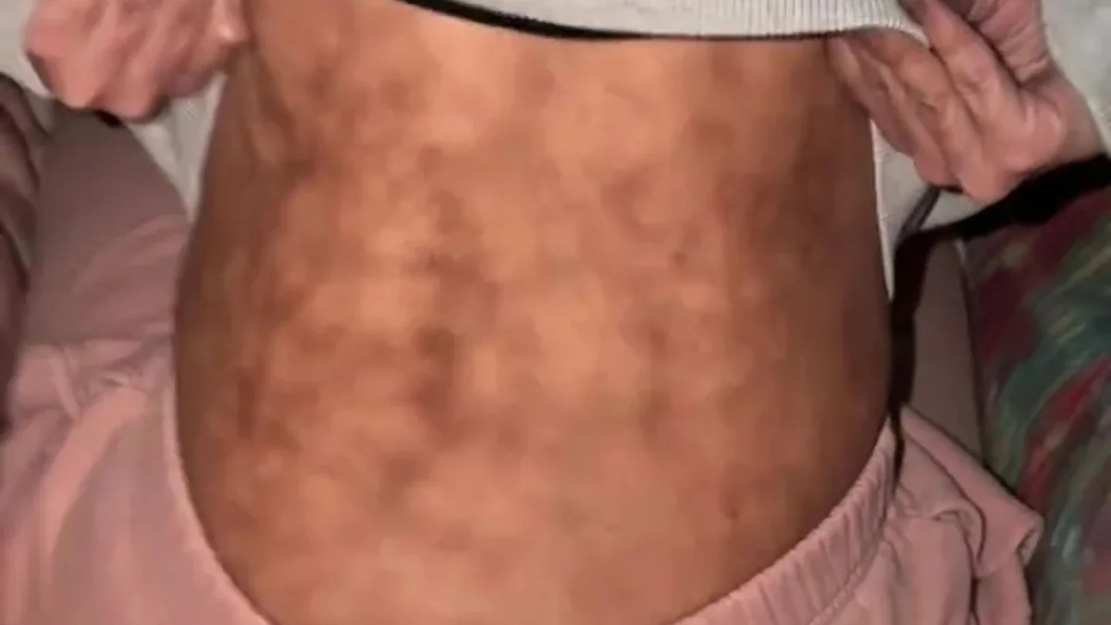 Winter Comfort, Hidden Risk: The Heating Pad Habit That Toasted Skin