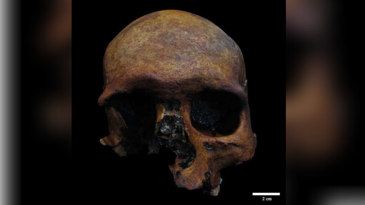 Unearthing a Battered Roman-era Skull: Violent Trauma and a Possible Brain Tumor in Spain