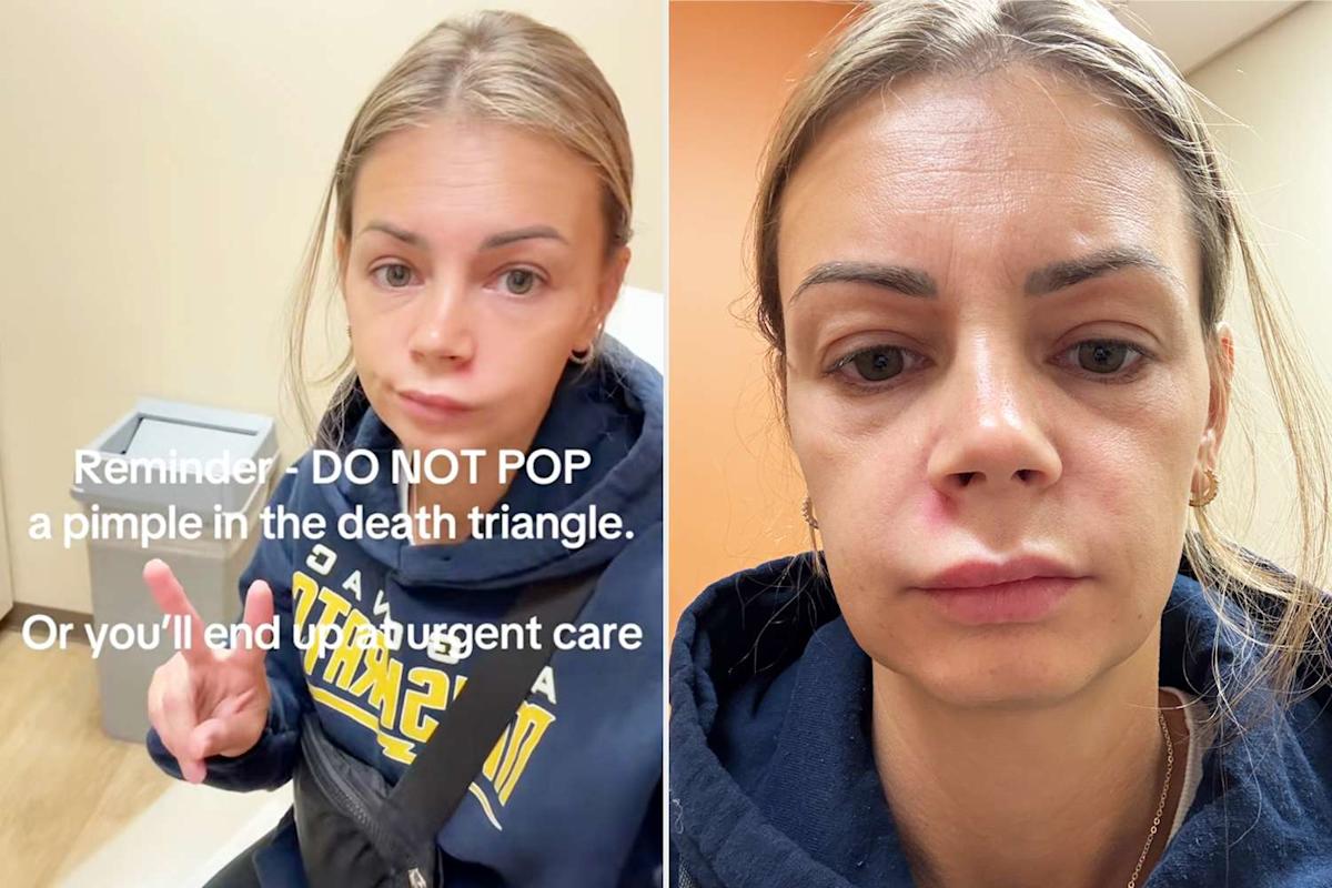 Featured image for Woman Hospitalized After Popping Pimple in 'Triangle of Death'