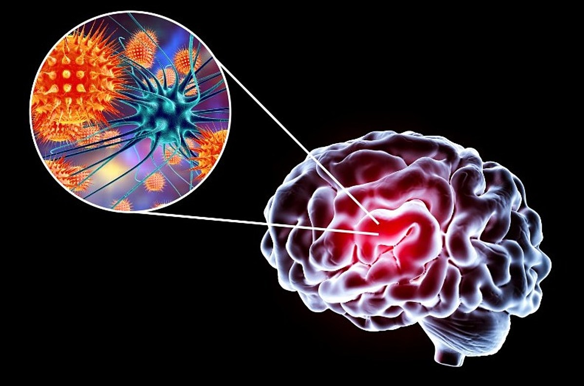 Featured image for "Outbreak of Rare, Severe Viral Disease Hits New York State"