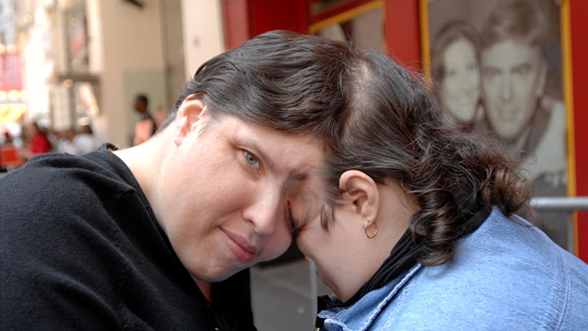 Featured image for "World's Oldest Conjoined Twins Lori and George Schappell Pass Away at 62 in Pennsylvania"
