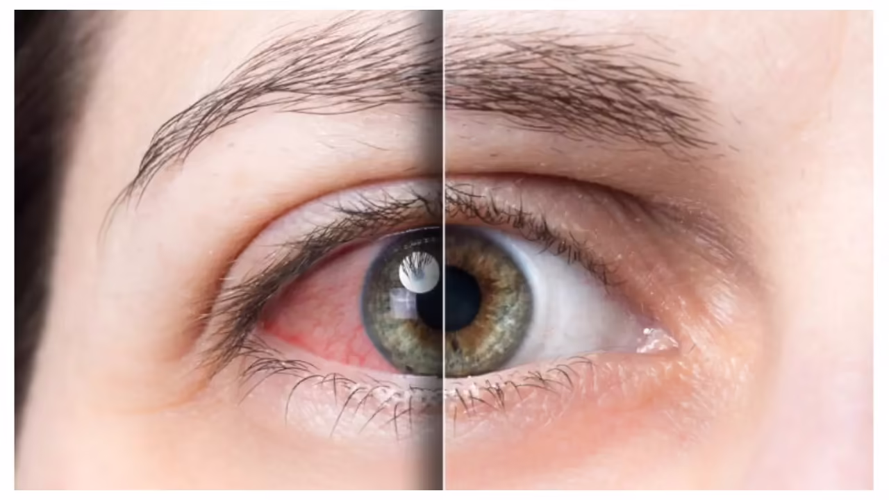 Featured image for How High Blood Sugar Affects Eye Health and Vision