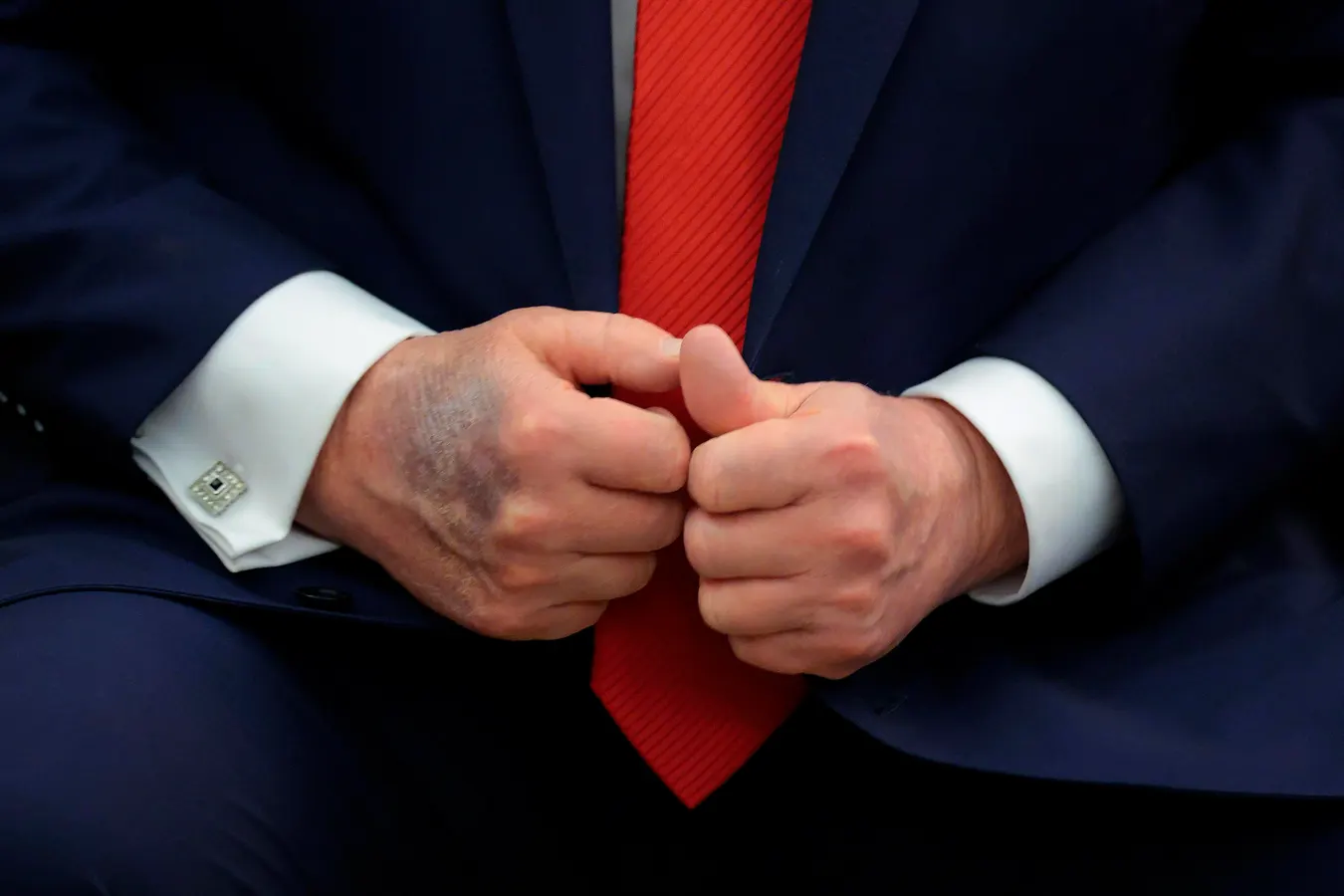 Featured image for Trump's Hand Bruise Sparks Health and Political Speculation