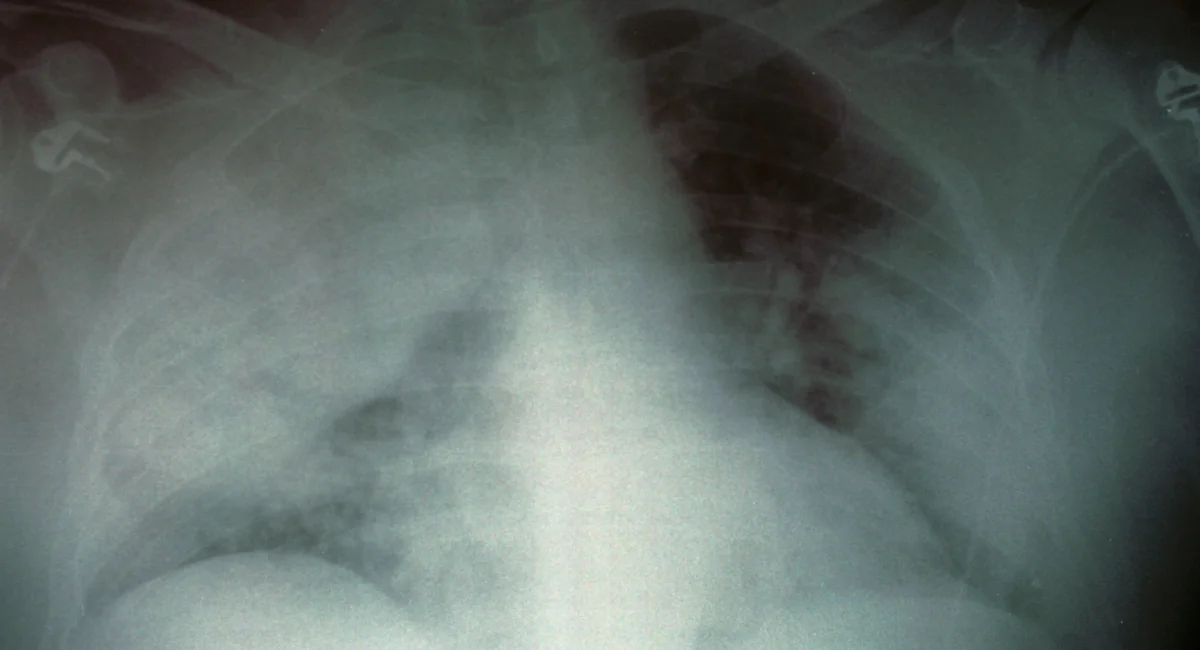 Featured image for Legionnaires' Disease Outbreak in Harlem: 2 Dead, 58 Infected