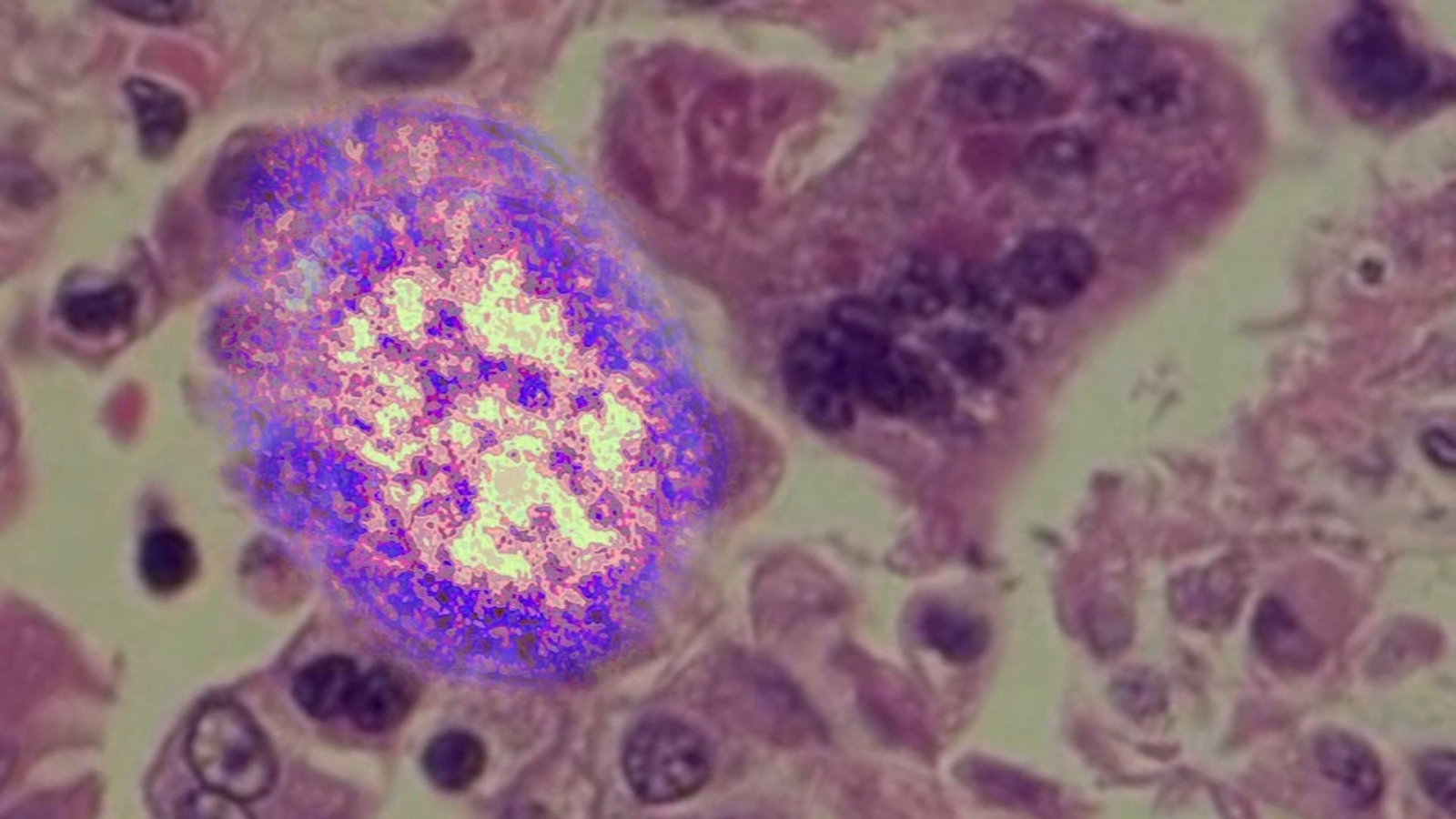 Featured image for Measles Outbreak Reported in Fresno County Home.