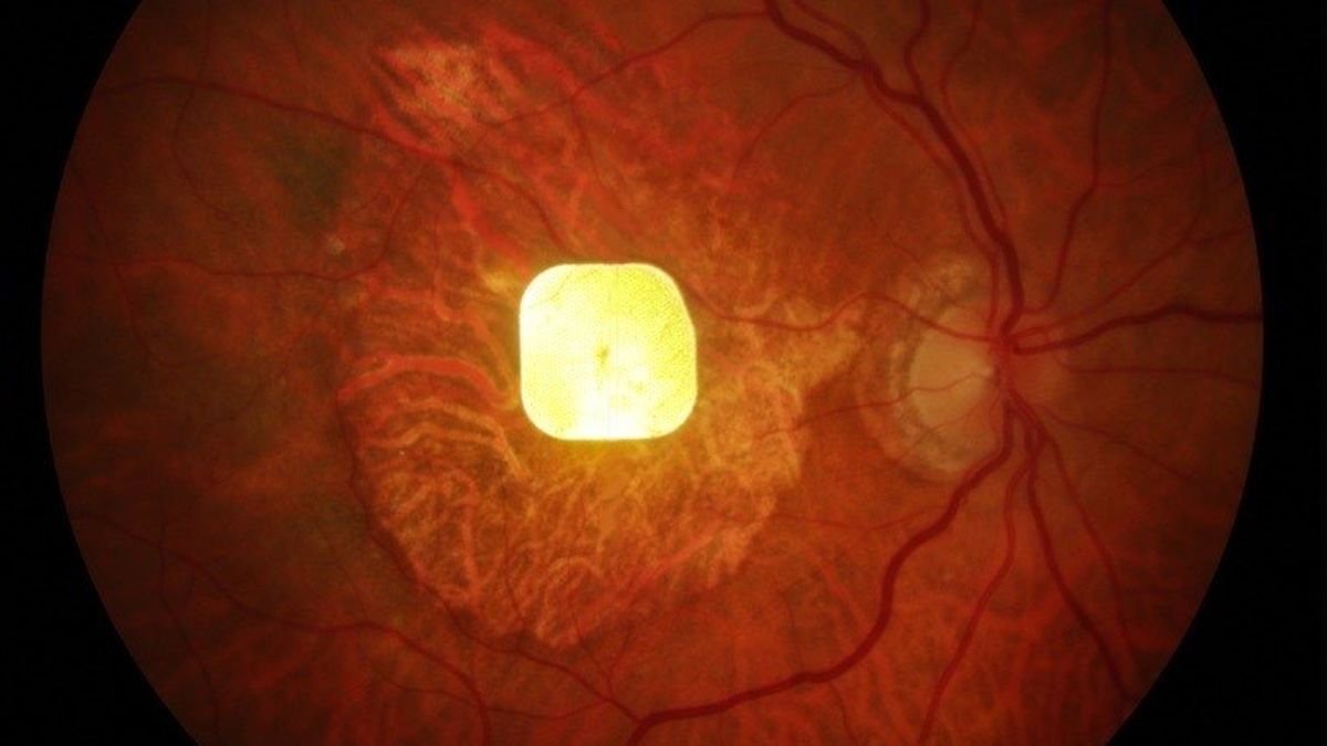 Featured image for Groundbreaking Eye Implant Restores Sight in Medical Breakthrough