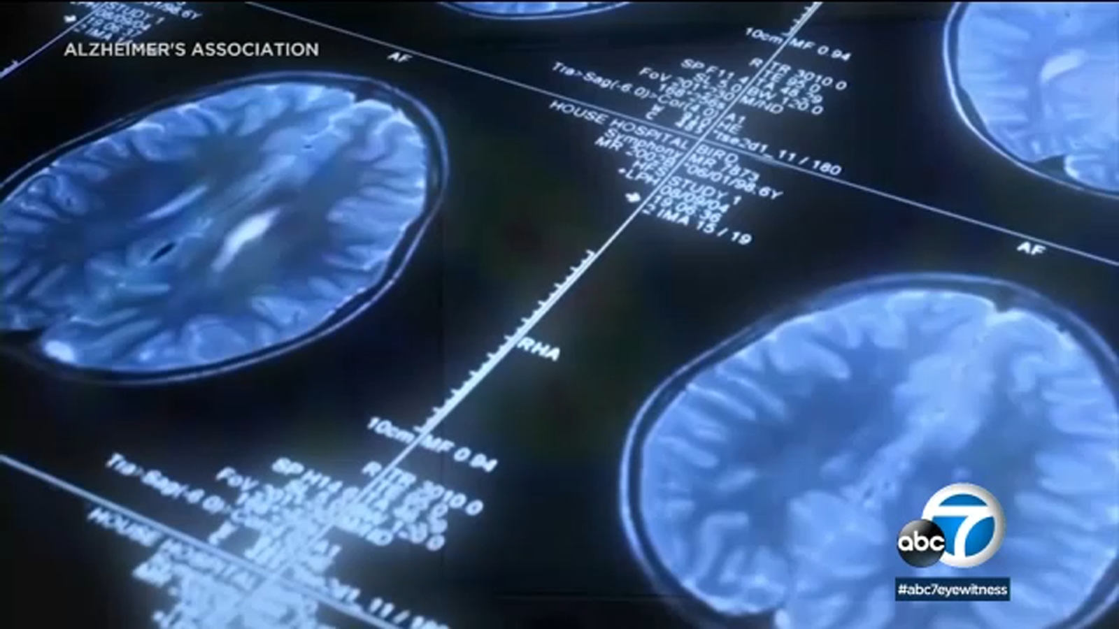 Alzheimer's Epidemic: LA County Leads, Early Detection Crucial