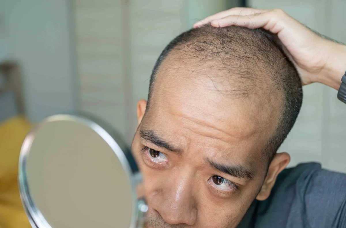 Featured image for "The Link Between Hair Loss and Vitamin Deficiency: Unveiling the Culprit"