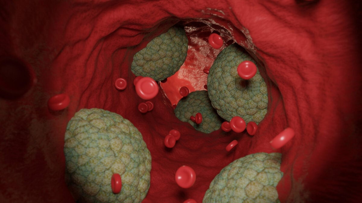Featured image for Germs and Bacteria: Uncovering Hidden Triggers of Heart Attacks