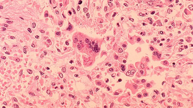 LA Child Dies from Rare Measles-Related Complication Years After Infection