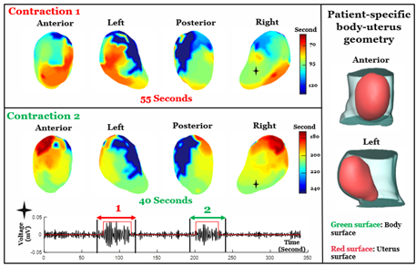 Featured image for Real-time 3D mapping of uterine contractions during labor with non-invasive imaging technology.