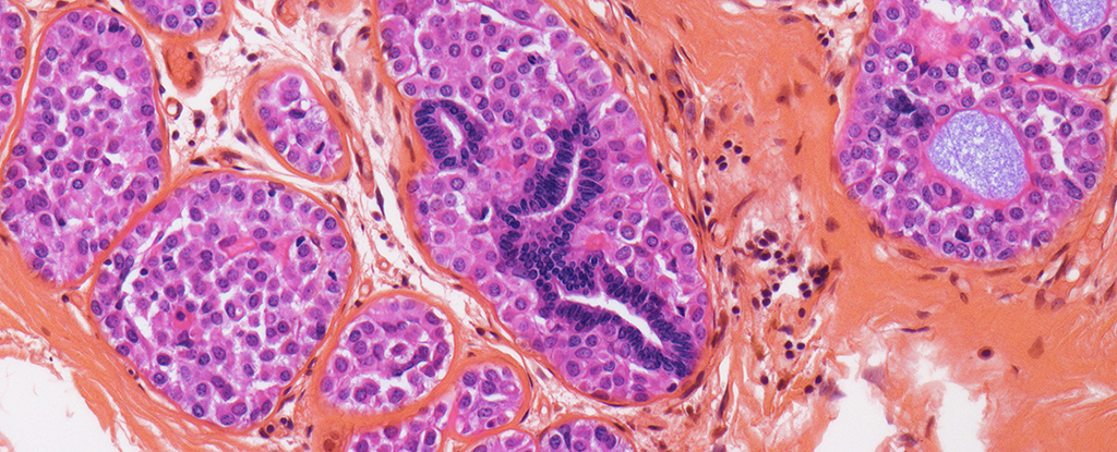 Featured image for New Approach Shows Promise in Preventing Breast Cancer Recurrence