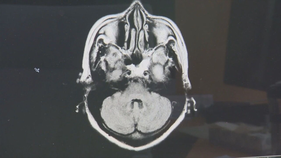 Featured image for "Worm Eggs Found in Man's Brain Causing Chronic Migraines"