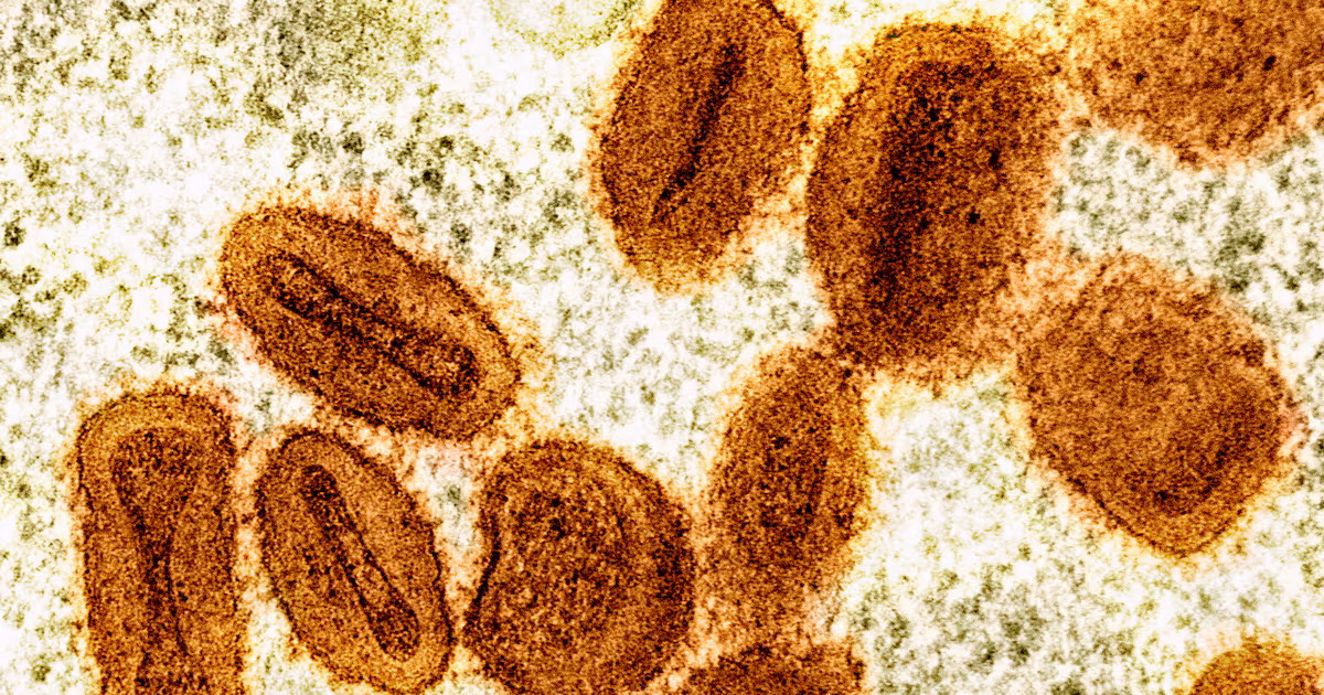 Featured image for Mpox Confirmed in Anchorage Adult After Out-of-State Travel