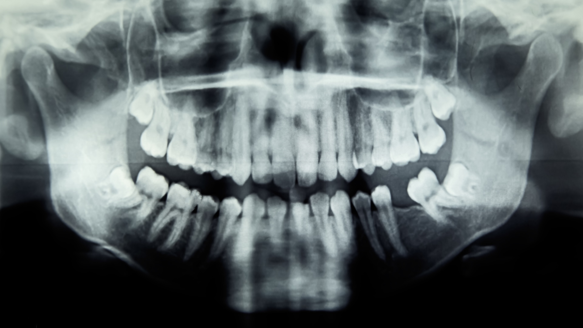 Featured image for Girl's Dental Issue Leads to Severe Eye Infection