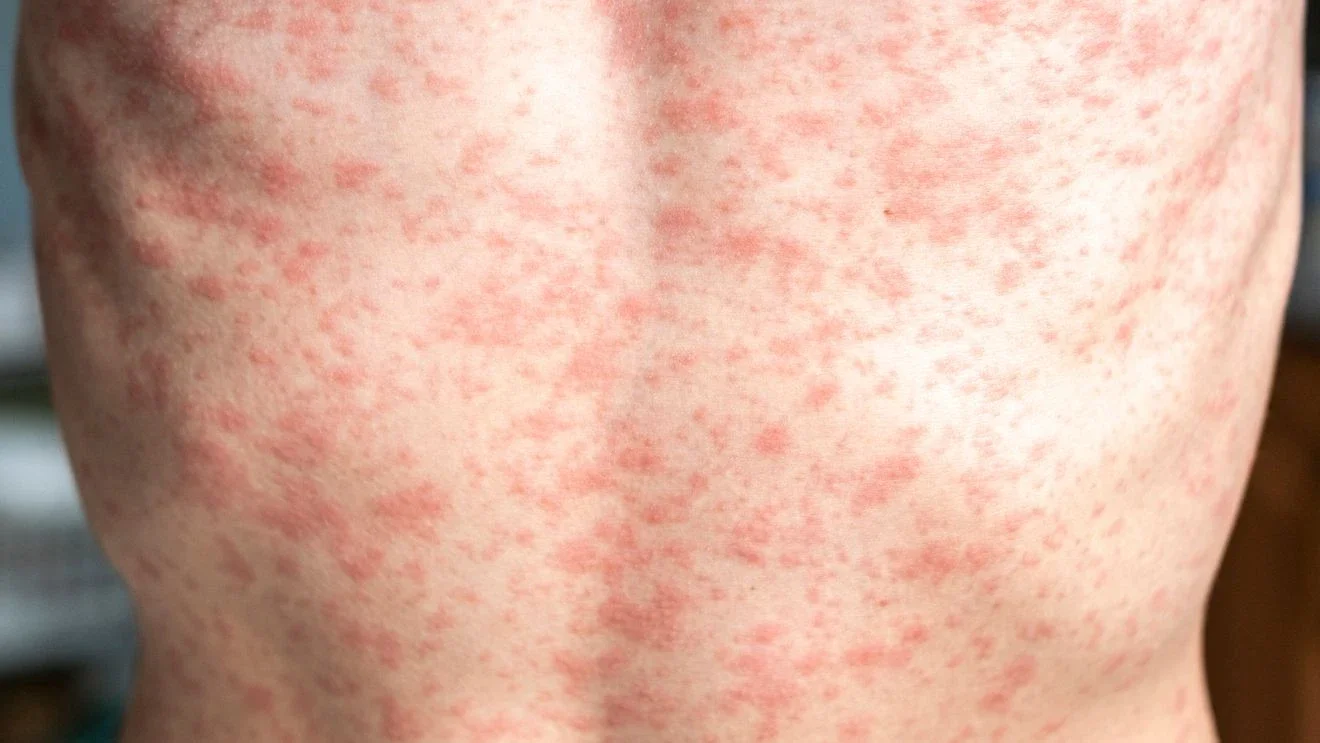 Public health alert issued after measles exposure at Clackamas Kaiser Sunnyside