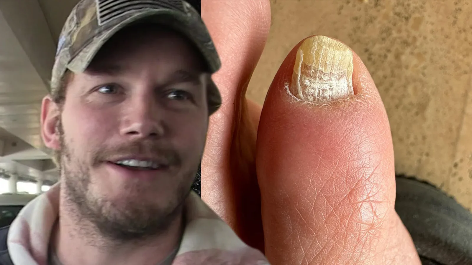 Chris Pratt's Toe Fungus Becomes Tabloid Fodder