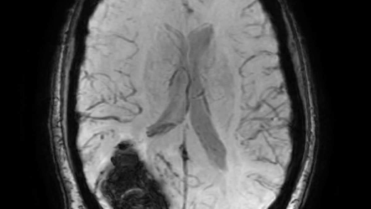 Featured image for Sex-Related Brain Bleeds: More Common Than Expected