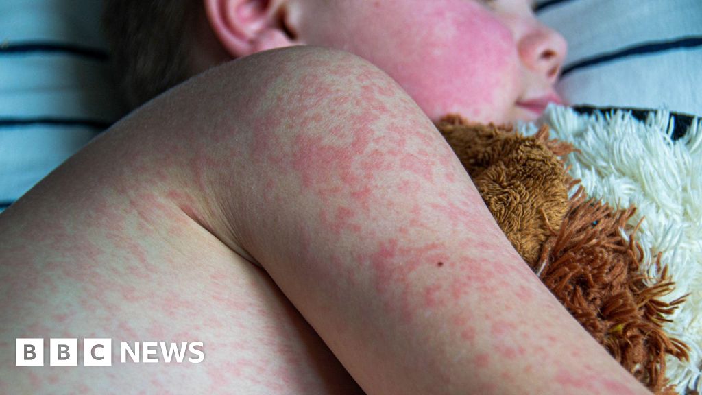 Featured image for UK Faces Measles and Mumps Surge: Vaccination Urged