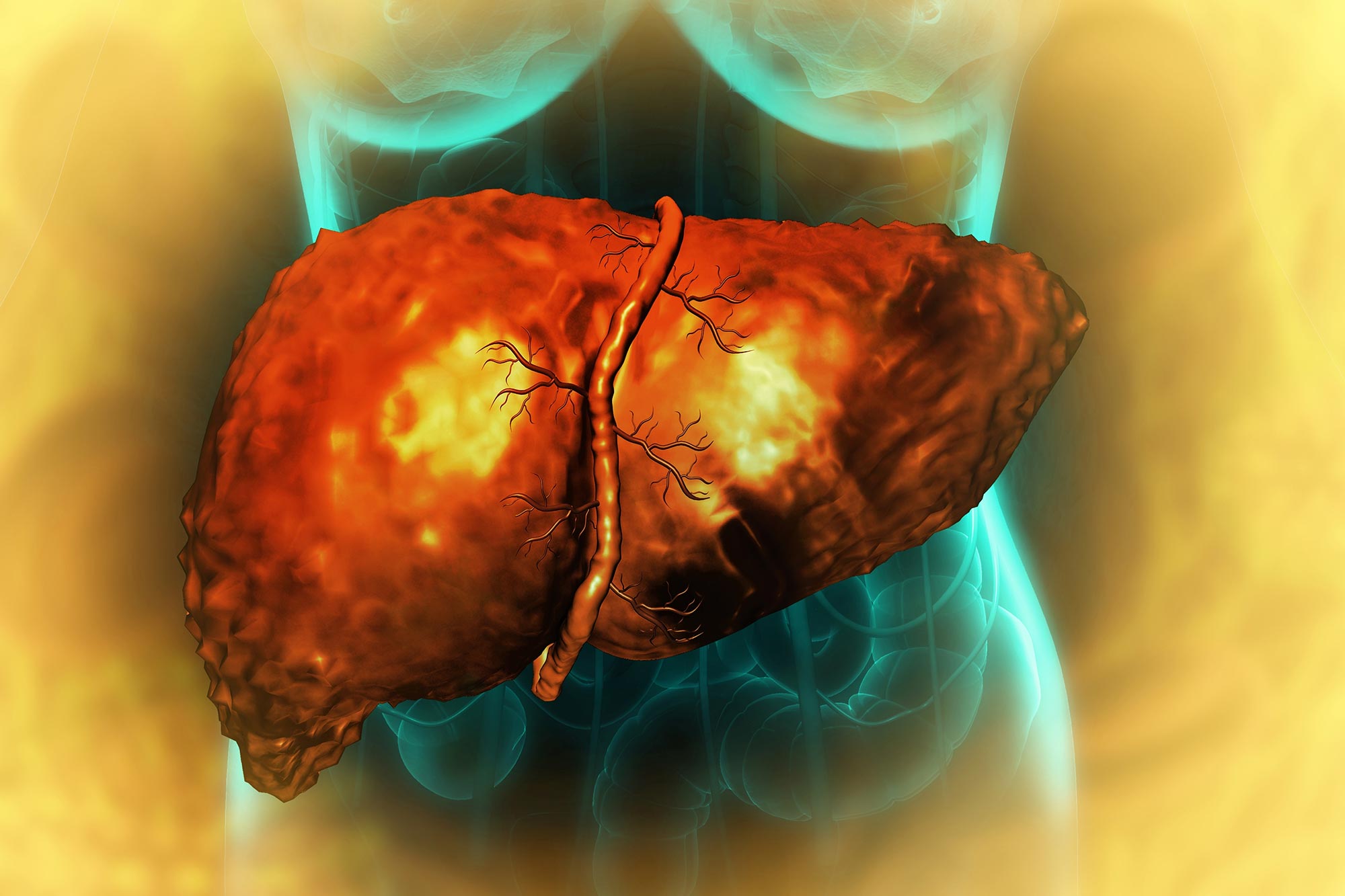 Featured image for High-Fat Diets May Trigger Liver Cancer Risk Years Before Tumors Develop