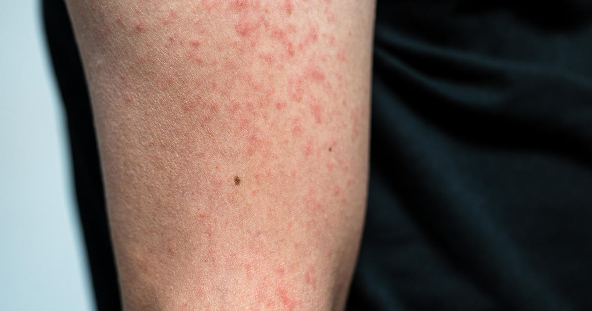 "Measles Outbreak Spreads Across Multiple States, CDC Reports"