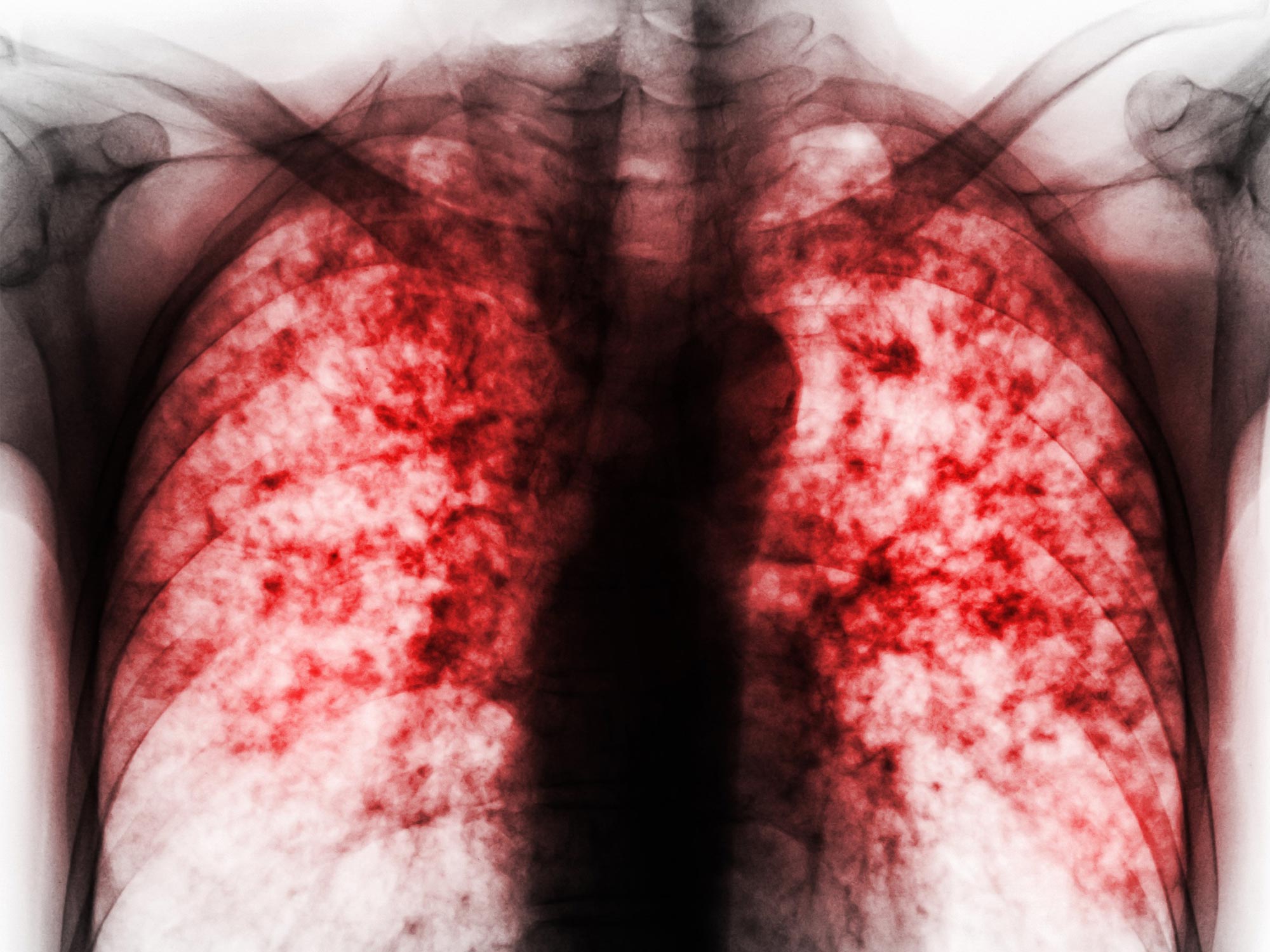 Featured image for Innovative Compounds and Inhibitors Paving the Way for Advanced Tuberculosis Treatments