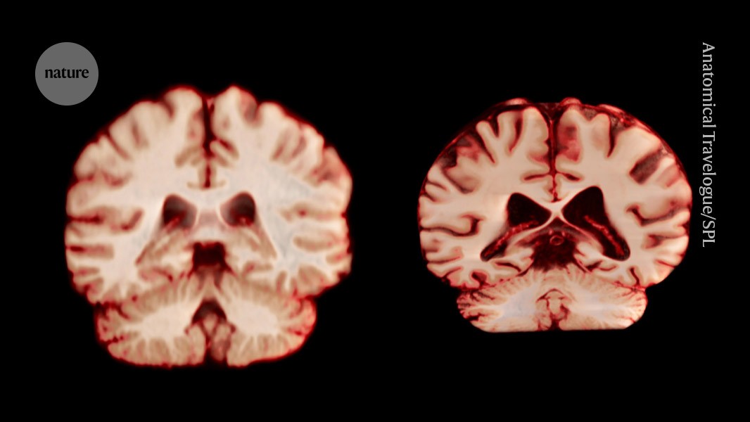 Featured image for Faster Brain Shrinkage in Men and Its Link to Alzheimer’s Risk