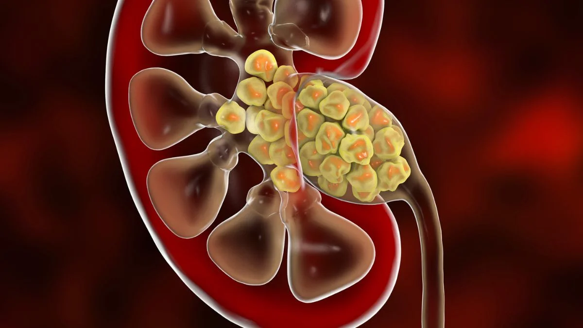 Bacteria Inside Kidney Stones Rewrite How Stones Form