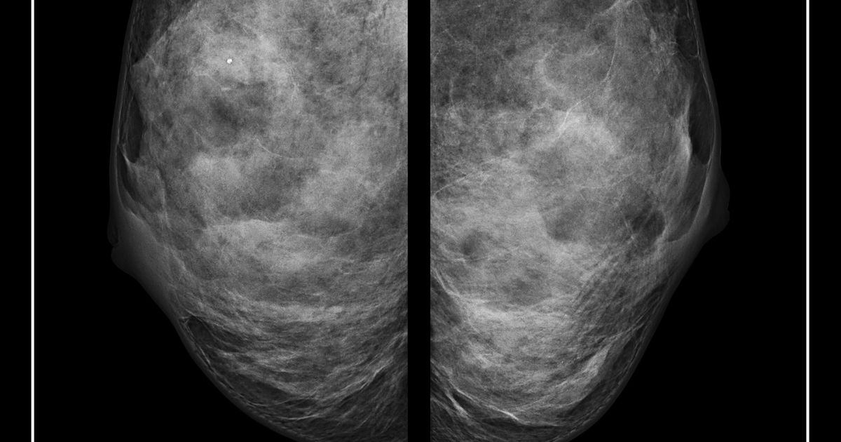 Featured image for "Hidden Threat: When Mammograms Miss Breast Cancer"