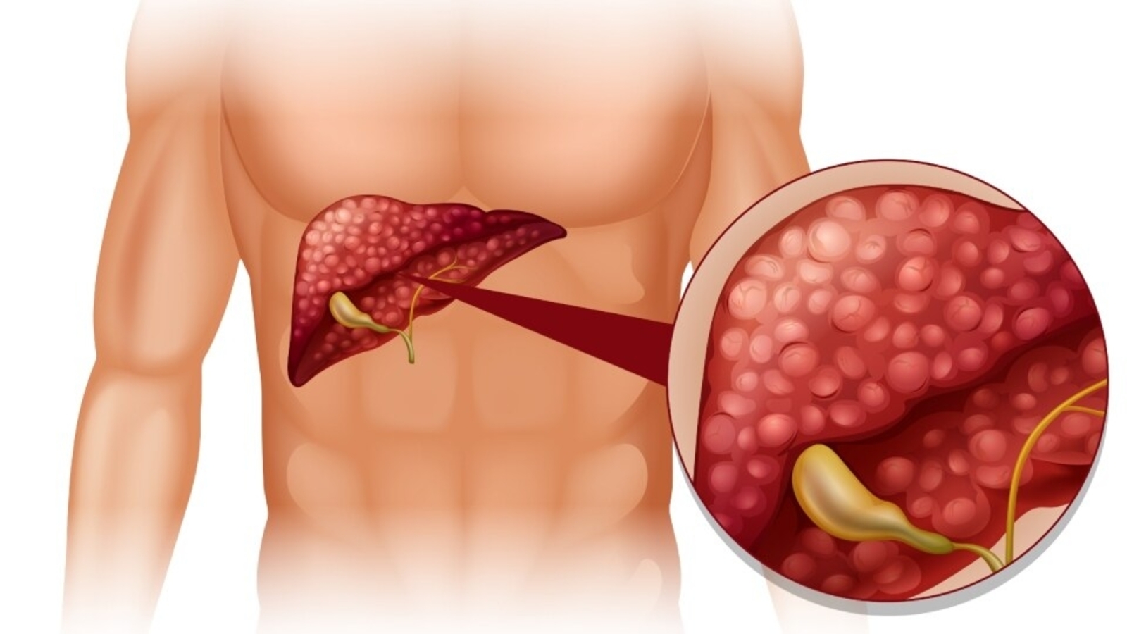 Featured image for Preventing Liver Cancer: Lifestyle Tips and Treatment Options