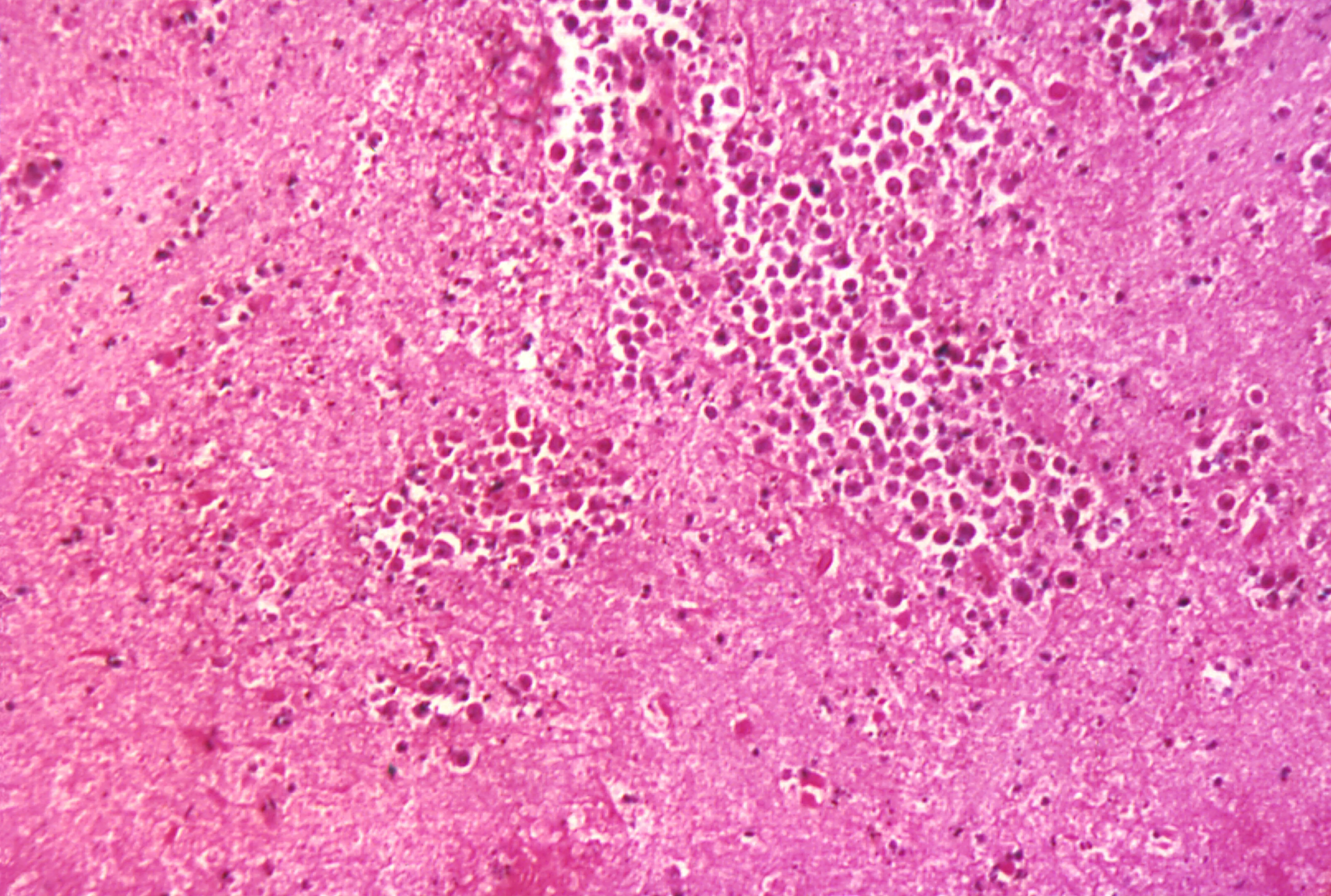 Fatal Brain-Eating Amoeba Claims Another Life in Georgia