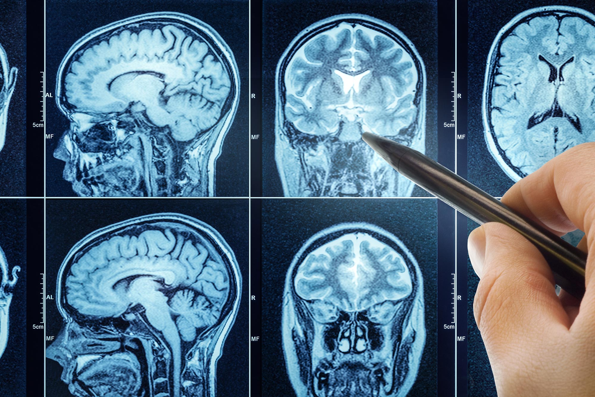 Featured image for Early Brain Signal Indicates Alzheimer's Risk Years Ahead