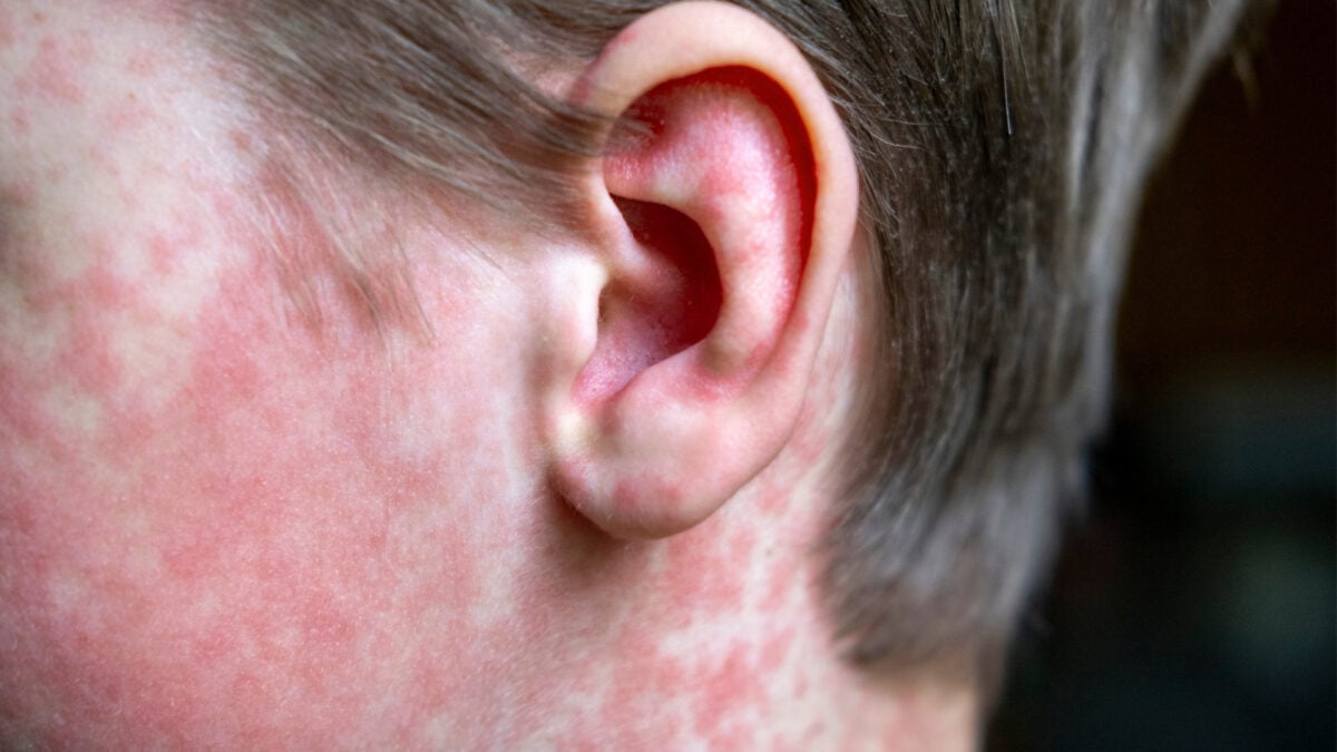 Measles Outbreak in Ontario Claims Infant Lives