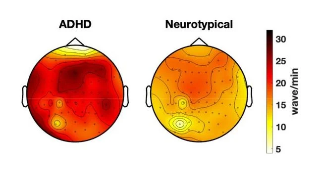 ADHD Inattention Linked to Wakeful 'Local Sleep' Brain Bursts