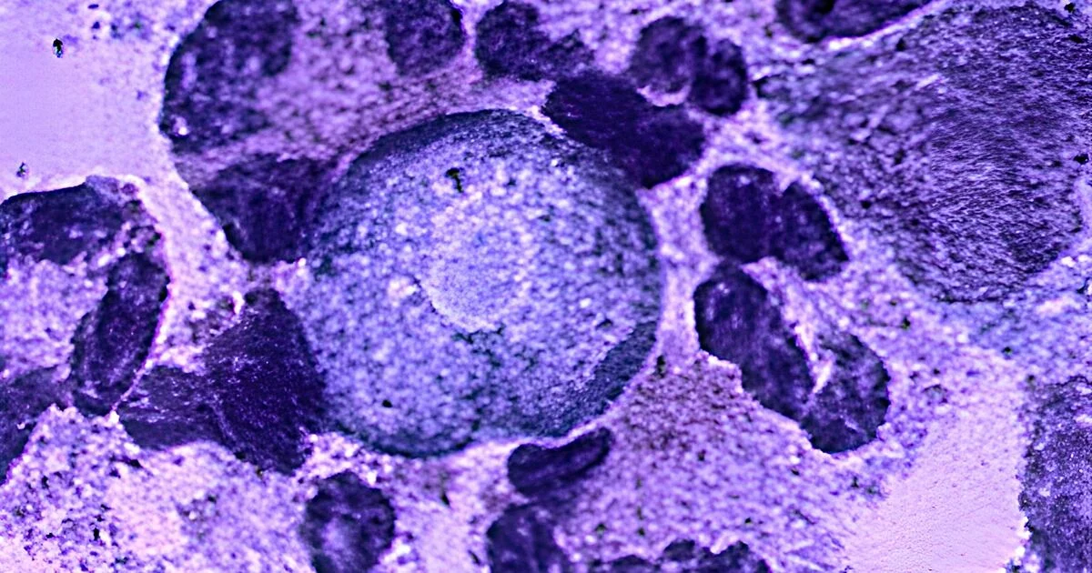 Texas Woman Dies from Brain-Eating Amoeba After Using Tap Water for Sinus Rinse