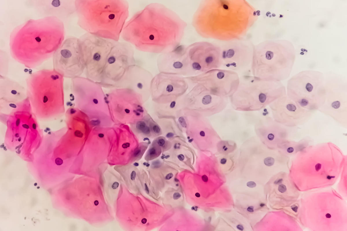 Featured image for "Rising HPV-Related Cervical Cancer: Urgent Need for Eradication"