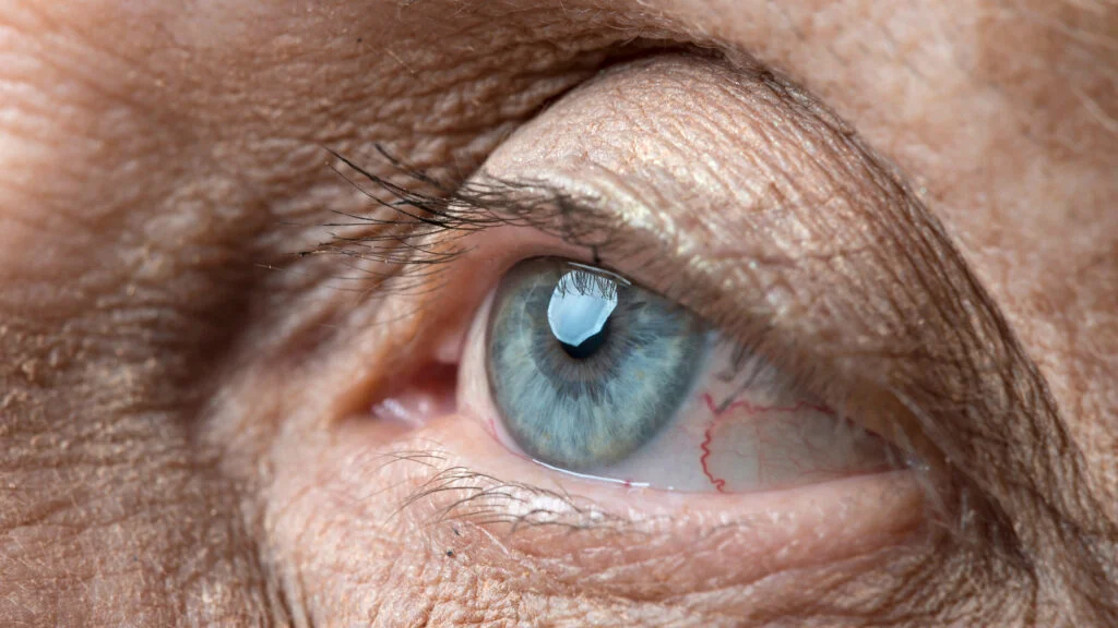 Ocular Therapeutix Prepares for Key Trial of Longer-Lasting Eye Treatment
