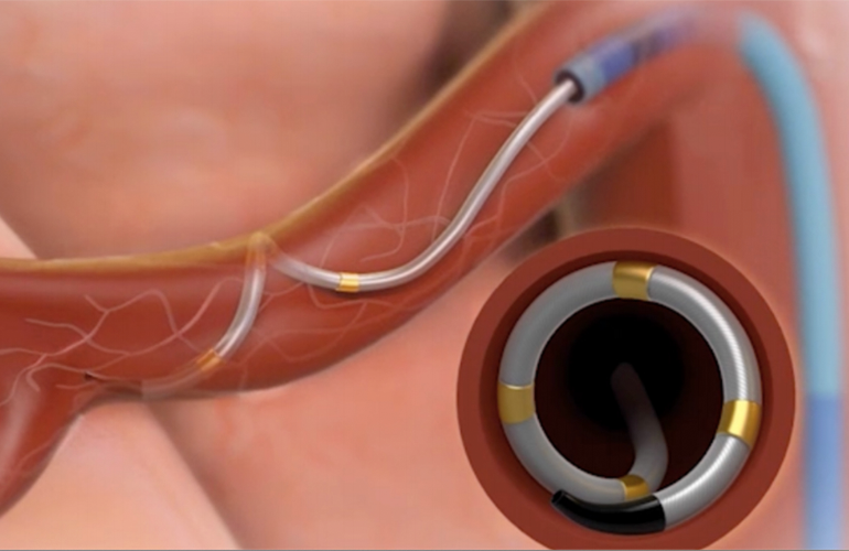 FDA Panel Rejects Medtronic's Symplicity Spyral RDN