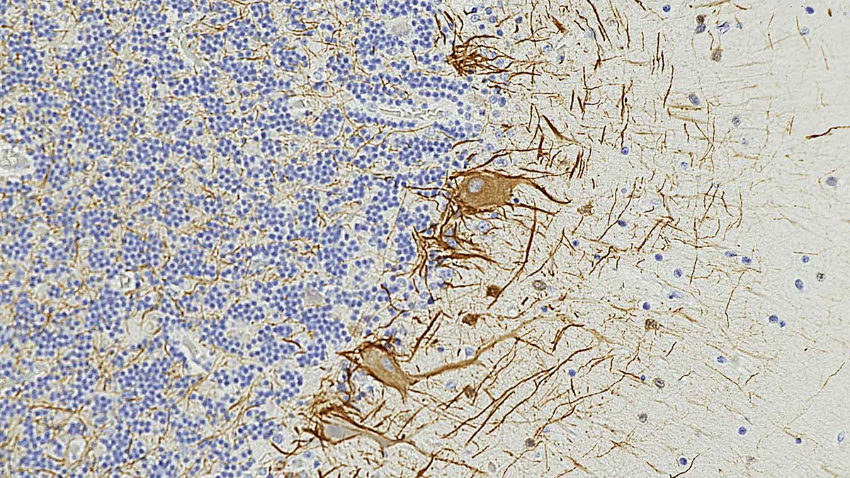 Featured image for Early Myelin Damage Signals May Predict Multiple Sclerosis Years Before Symptoms