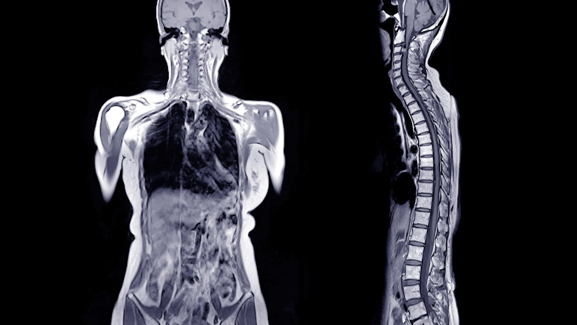 Featured image for Rising Alpha-Gal Syndrome: A Hidden Threat from Backyard Bugs